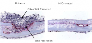 Osteoclast formation and bone resorption resulting from transplant of particulate matter into mice